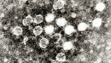 Zytomegalievirus und Parvovirus B19 (2)