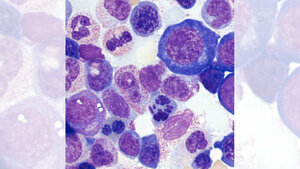 Titelbild zum zweiten Teil des Fachbeitrags über Myelodysplastische Syndrome, speziell: MDS ohne Blastenvermehrung