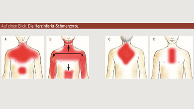 Die Herzinfarkt-Schmerzorte. 
