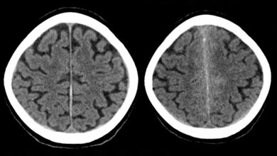 Subarachnoidale Blutung neben der Falx 