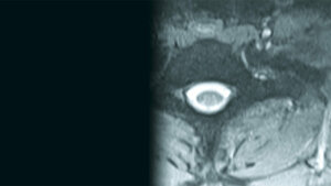 Spinale Malformationen: Stummelrippen und Querfortsatzanomalie der Halswirbelsäule