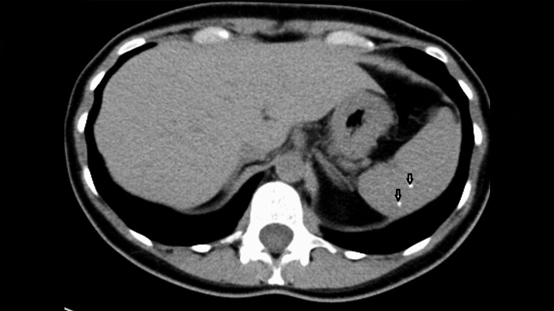 CT des Abdomen mit Phlebolithen der Milz