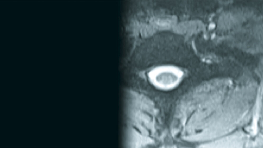 Spinale Malformationen: Stummelrippen und Querfortsatzanomalie der Halswirbelsäule