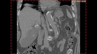 Zufallsbefunde: Cholezystolithiasis Schnittbilddiagnostik der Wirbelsäule (7.23)