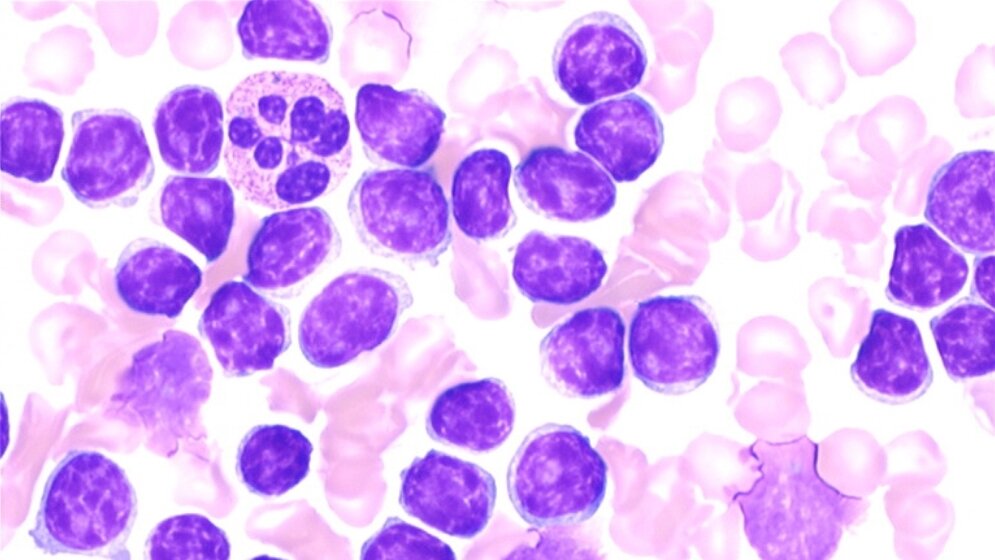 Leukämiezellen