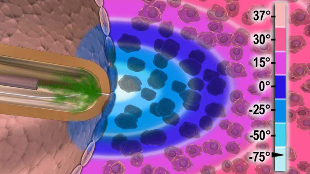Kryoablation 