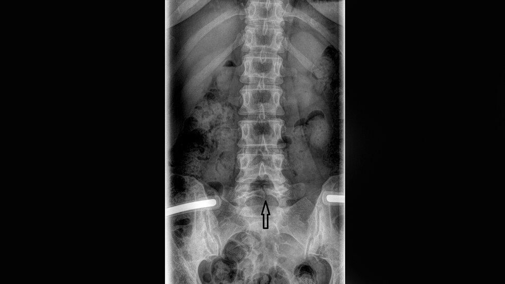 Bildgebende Verfahren Anomalien und Normvarianten: Skelettale Veränderungen 3.15