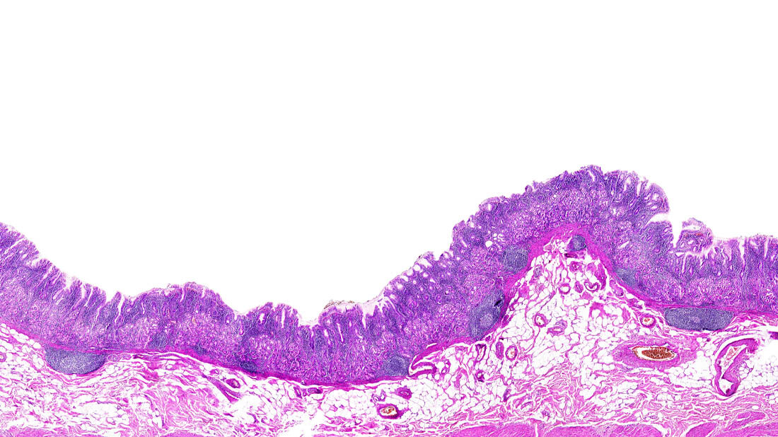 Bild von chronischer Gastritis