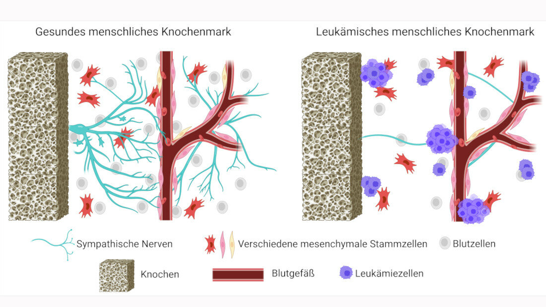 Knochenmark.jpg Vereinfachtes Schema des gesunden und leukämischen menschlichen Knochenmarks.