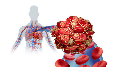 Thrombosefrueherkennung.jpg Lungenembolie