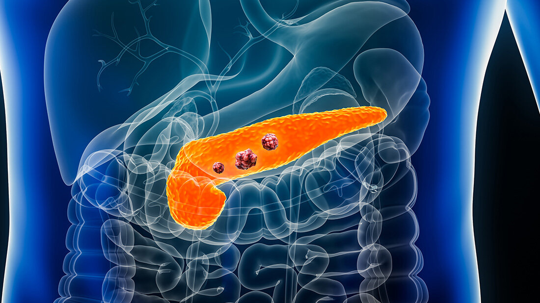 Vorteile die Positronen-Emissions-Tomographie (PET) bei der Diagnose von Bauspeicheldrüsenkrebs