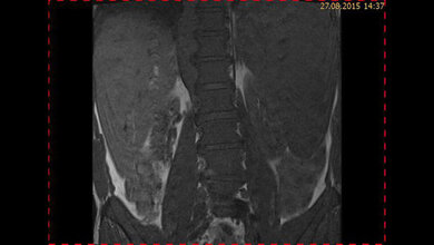 Schnittbilddiagnostik der Wirbelsäule (4.23)