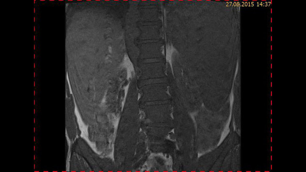 Tumoröse Veränderungen: Non-Hodgkin-Lymphom Schnittbilddiagnostik der Wirbelsäule (4.23)
