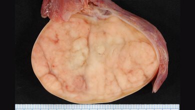 Präparat eines Seminoms