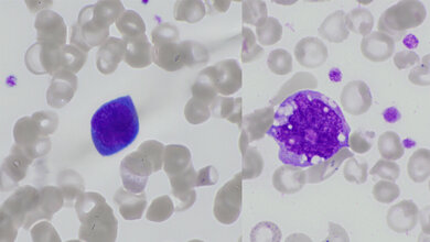 Titelbild zum Fachbeitrag über morphologische Veränderungen der Zellen im peripheren Blutausstrich bei COVID-19