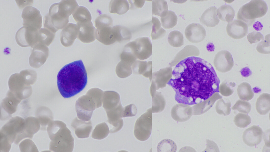 COVID-19 und die morphologischen Veränderungen der Zellen Titelbild zum Fachbeitrag über morphologische Veränderungen der Zellen im peripheren Blutausstrich bei COVID-19