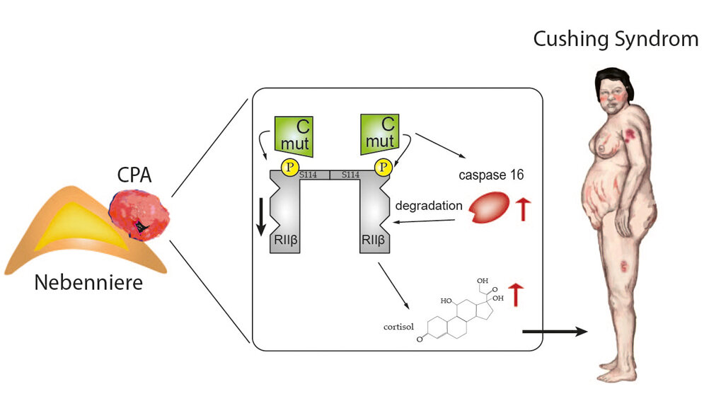 Cushing-Syndrom
