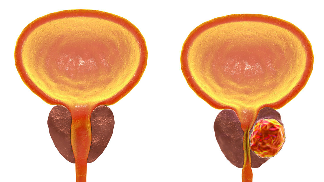 Prostatakrebs_Adobe_01.jpg Symbolbild für Prostatakrebs