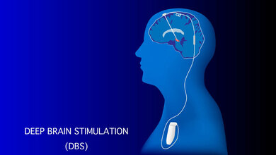 Tiefenhirnstimulation