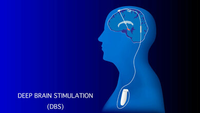 Tiefenhirnstimulation