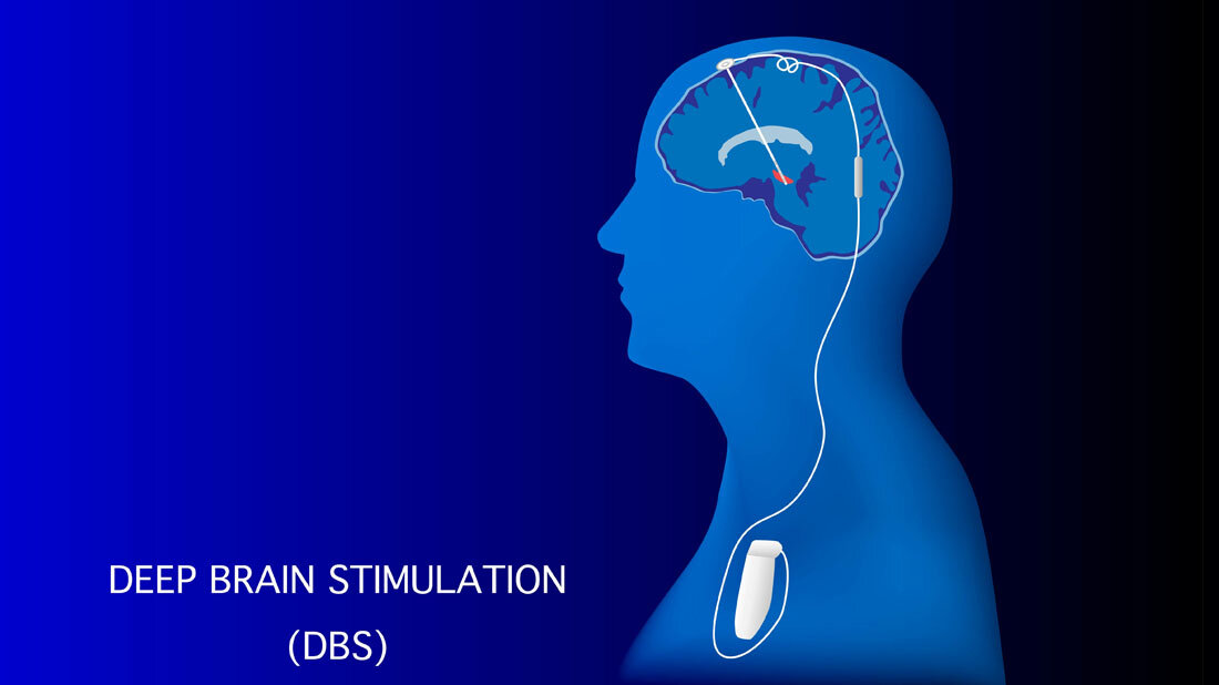 Tiefenhirnstimulation