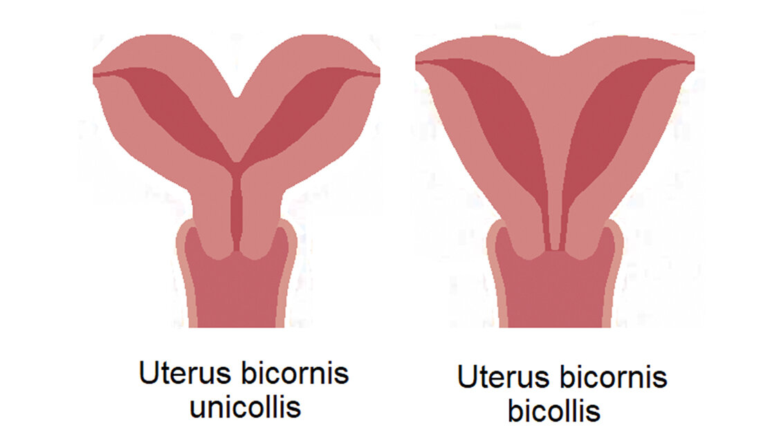 Anomalien und Normvarianten – Interne Veränderungen 2.32: Uterus bicollis bicornis Schematische Darstellung von Uterus bicornis unicollis und Uterus bicornis bicollis
