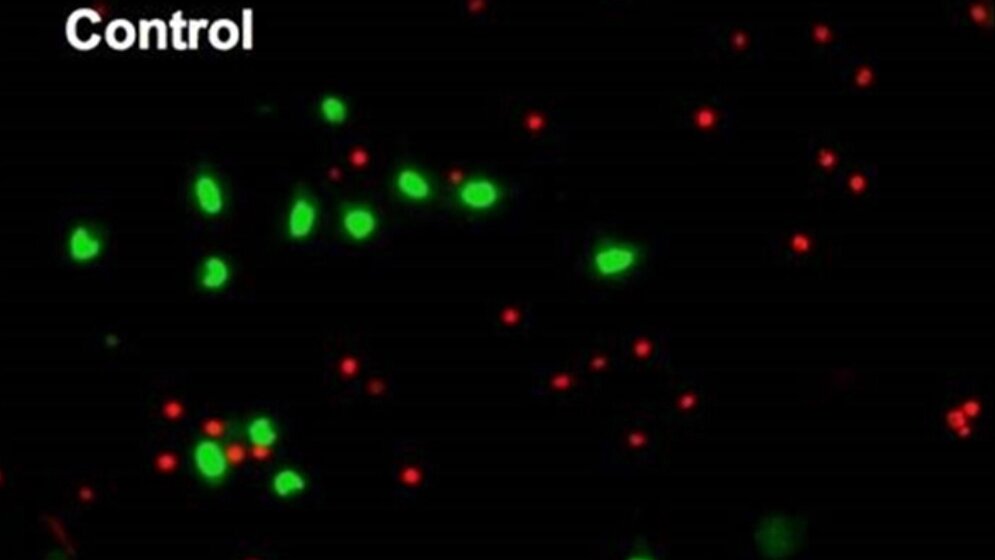 α-Synuklein-Ansammlungen 