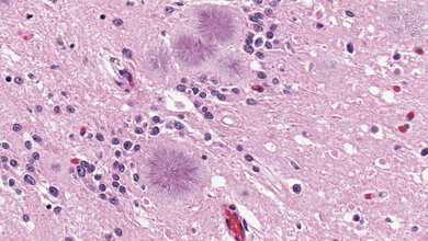 Variante Creutzfeldt-Jakob Krankheit 