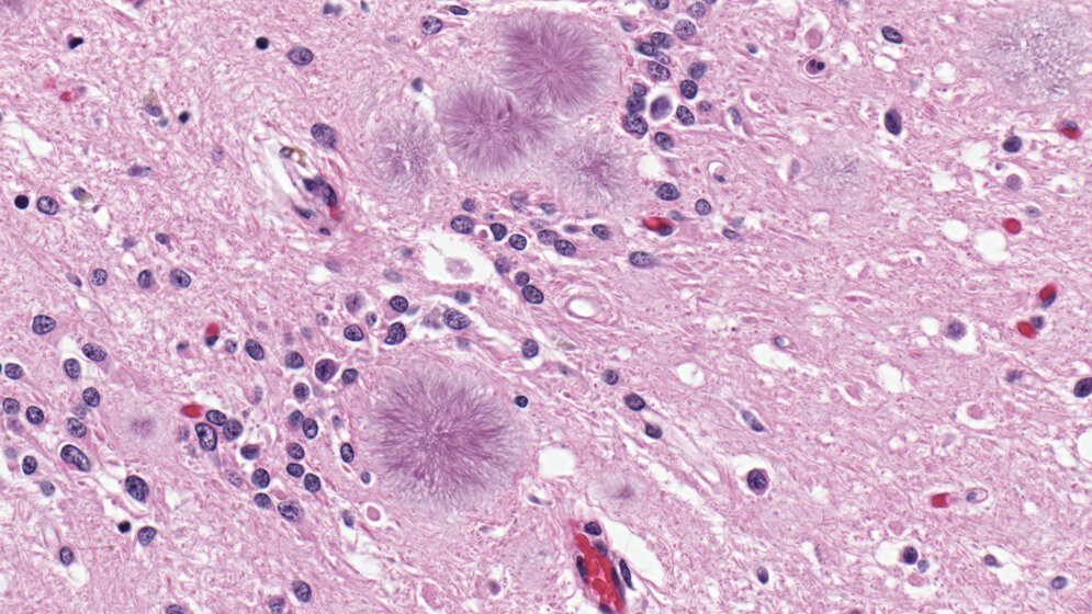 Variante Creutzfeldt-Jakob Krankheit 