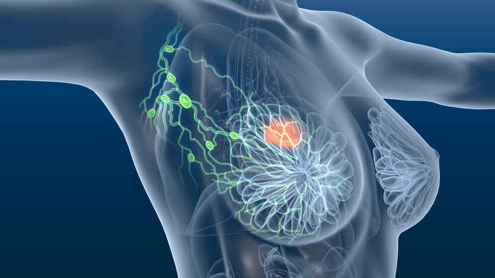 Teilbrustbestrahlung