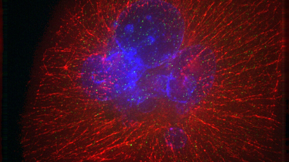 Bauchspeicheldrüsenkrebszelle