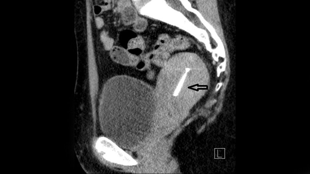 Bildgebende Verfahren Anomalien und Normvarianten – Interne Veränderungen 2.8
