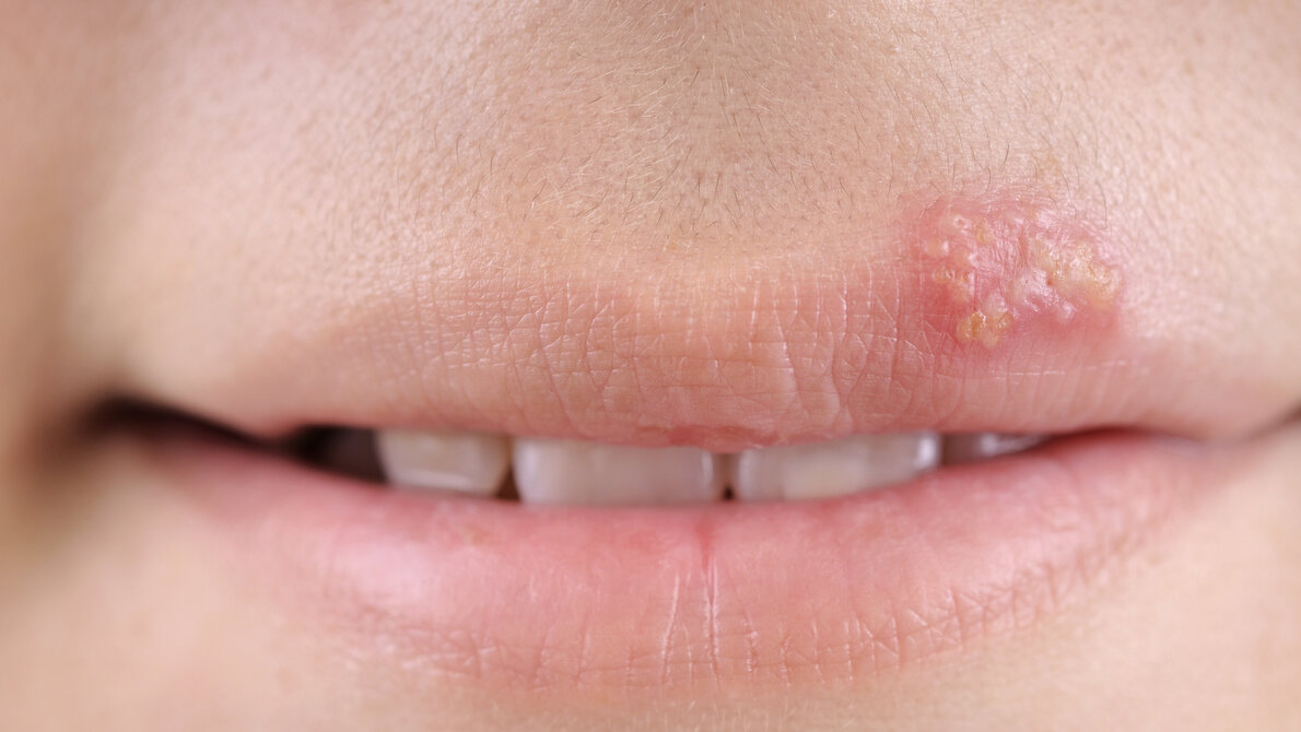 Es werden Lippen mit Herpesbläschen gezeigt.