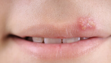 Es werden Lippen mit Herpesbläschen gezeigt.