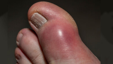 Gicht am großen Fußzeh.