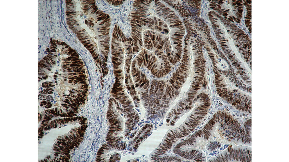 Immunhistochemische Färbung des „bösen Bruders“