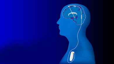 Tiefe Hirnstimulation 