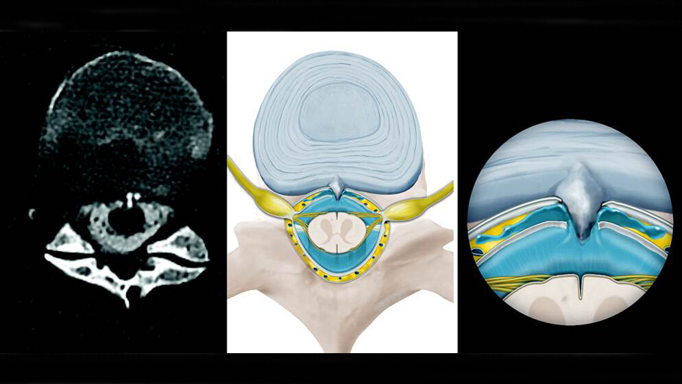 verkalkter_Mikrosporn_Insel_Gruppe_21092016.jpg verkalkter Mikrosporn schneidet Dura aus