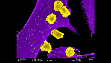Killer T Lymphozyten (kleine Zellen) erkennen und zerstören eine Tumorzelle 
