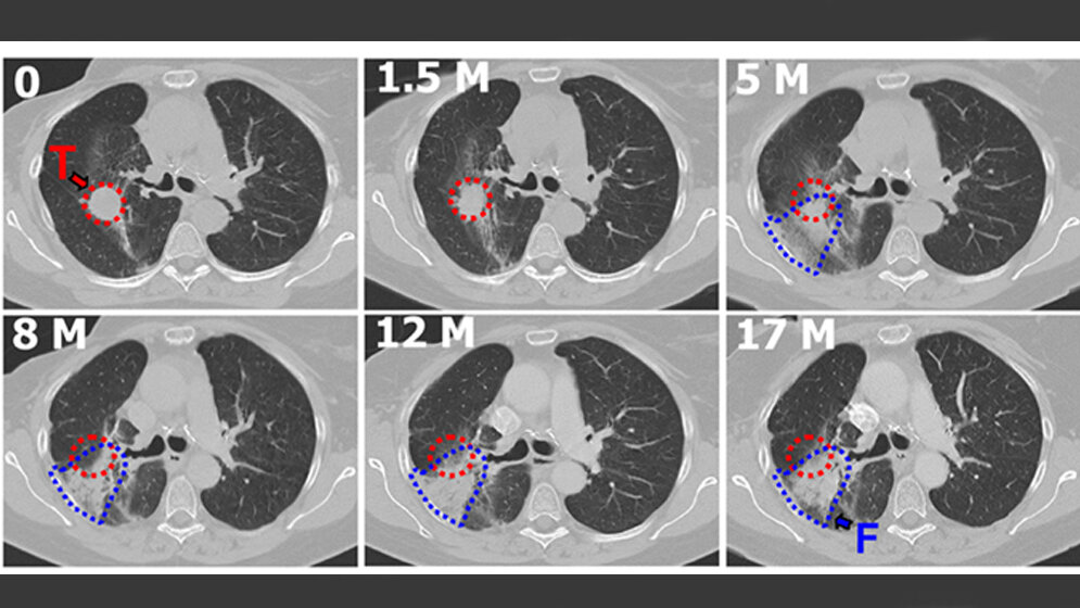 Lungenfibrose nach Bestrahlung