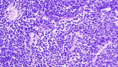 Diagnose_neuroektodermaler_Tumor_des_Zentralnervensystems_Dominik_Sturm__KiTZ.jpg Diagnose „neuroektodermaler Tumor des Zentralnervensystems“