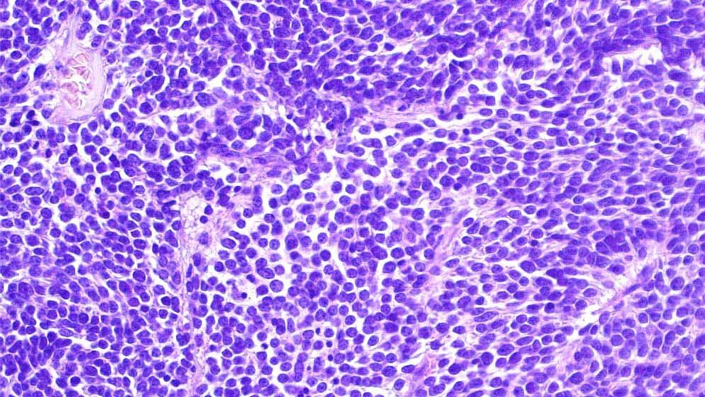 Diagnose_neuroektodermaler_Tumor_des_Zentralnervensystems_Dominik_Sturm__KiTZ.jpg Diagnose „neuroektodermaler Tumor des Zentralnervensystems“