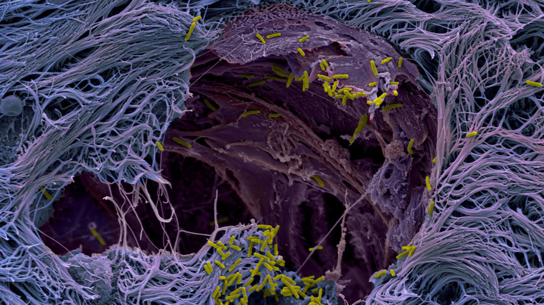 Pseudomonas_aeruginosa_in_der_Lunge.jpg Der Krankenhauskeim Pseudomonas aeruginosa durchbricht die Abwehrlinie des Lungengewebes