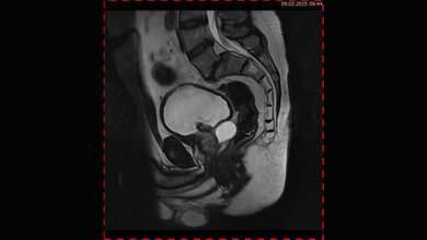 Zufallsbefunde: Samenblasenzyste