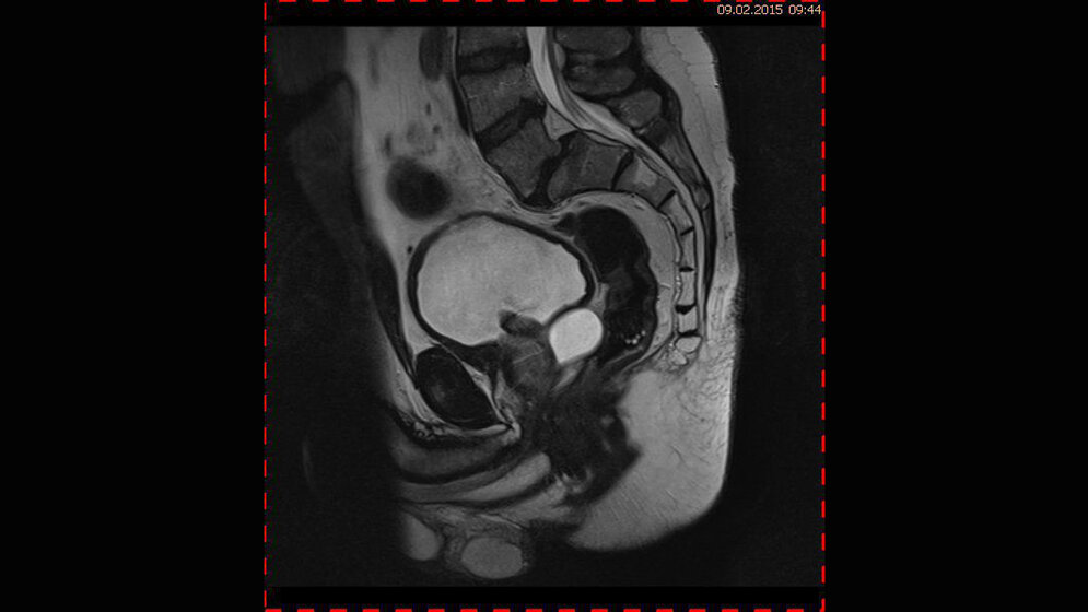 Zufallsbefunde: Samenblasenzyste