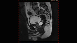 Zufallsbefunde: Samenblasenzyste