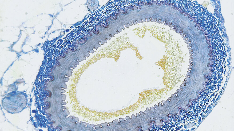 Periphere arterielle Verschlusskrankheit