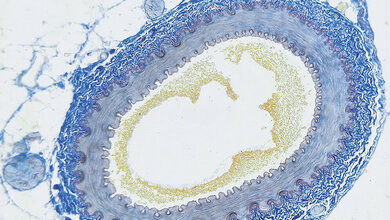 Arterie Periphere arterielle Verschlusskrankheit