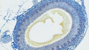 Periphere arterielle Verschlusskrankheit