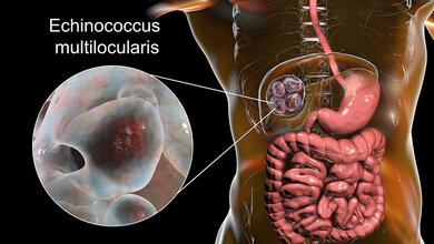 Schematische Darstellung des Befalls mit Echinococcus